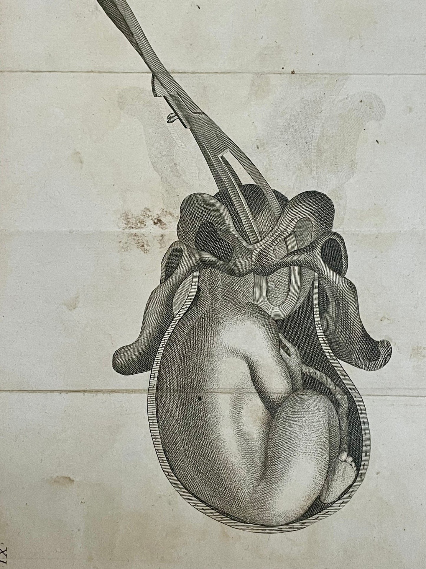 Lotto n. 6 antiche incisioni mediche ostetricia Baudelocque fine ‘700