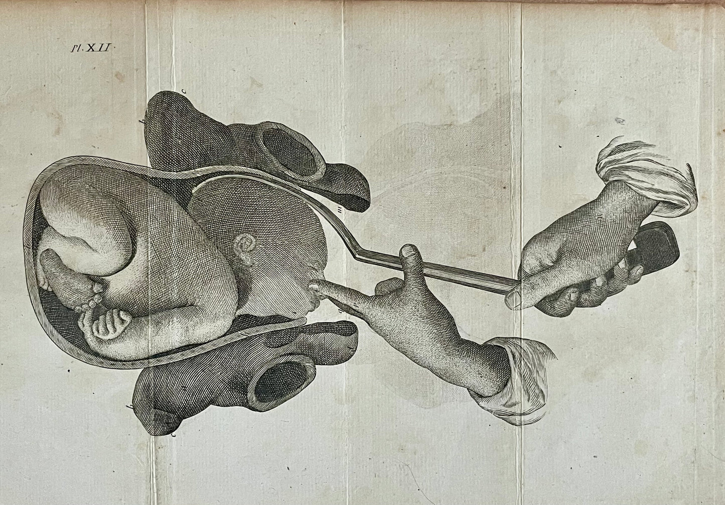 Lotto n. 6 antiche incisioni mediche ostetricia Baudelocque fine ‘700
