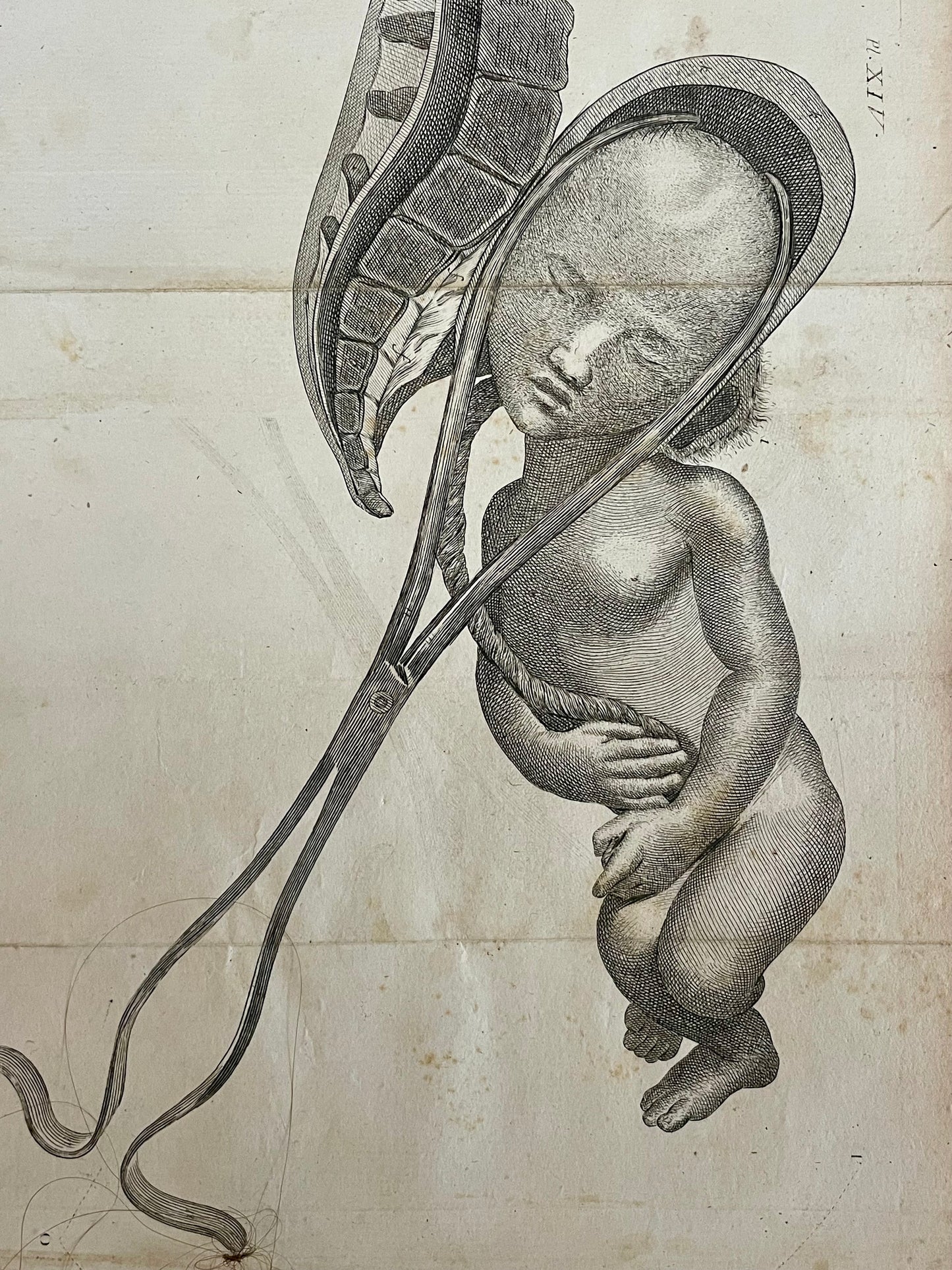 Lotto n. 6 antiche incisioni mediche ostetricia Baudelocque fine ‘700