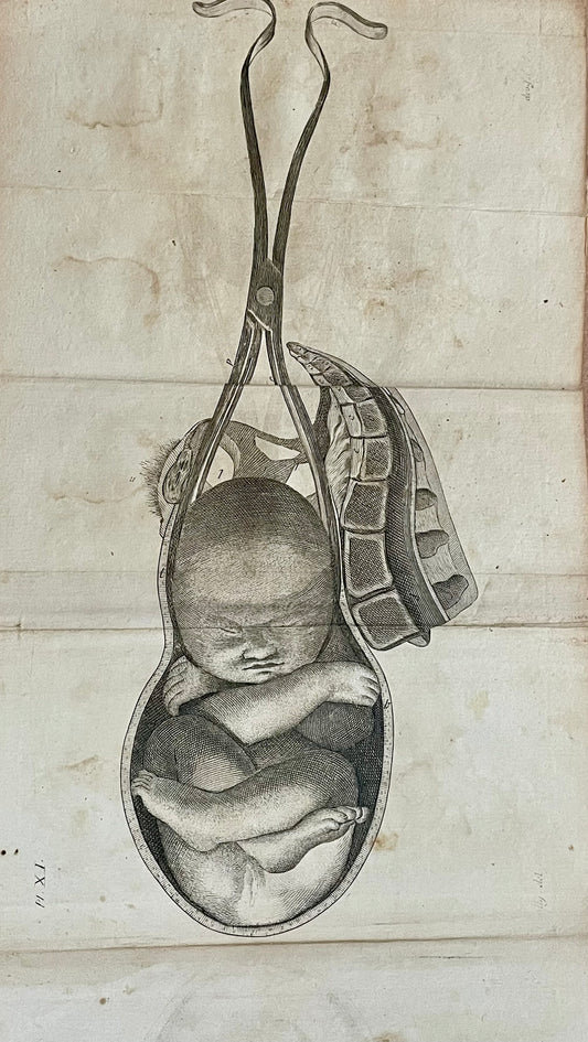 Lotto n. 6 antiche incisioni mediche ostetricia Baudelocque fine ‘700